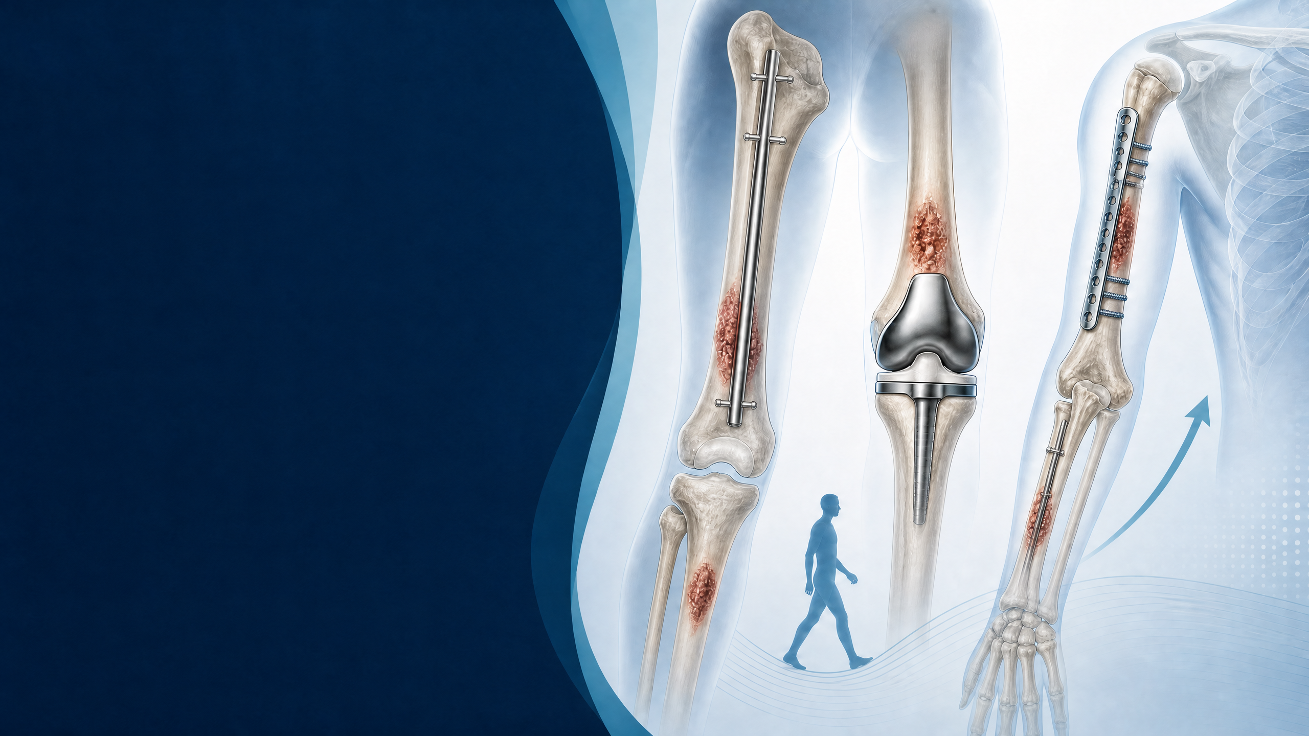 Evaluating surgical techniques for bone metastasis in the extremities