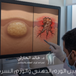 الفرق بين الورم الدهني والورم السرطاني