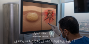 الفرق بين الورم الدهني والورم السرطاني